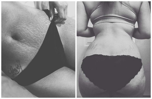 Mujeres comparten fotos de sus estrías para campaña viral