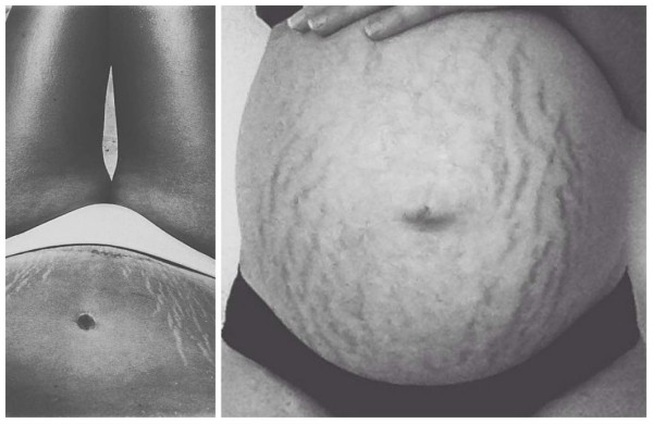 Mujeres comparten fotos de sus estrías para campaña viral