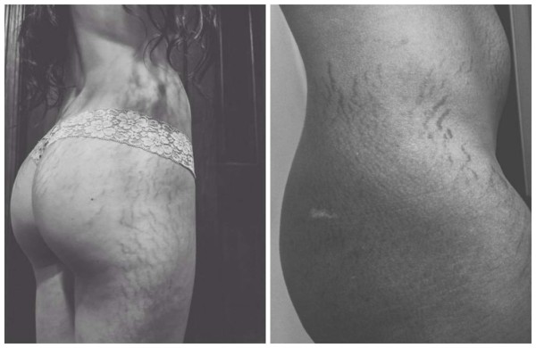 Mujeres comparten fotos de sus estrías para campaña viral