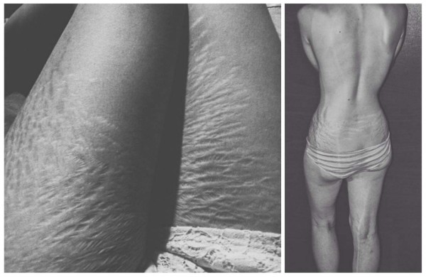 Mujeres comparten fotos de sus estrías para campaña viral