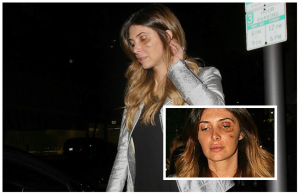 Ex de Luis Miguel aparece con golpes en la cara