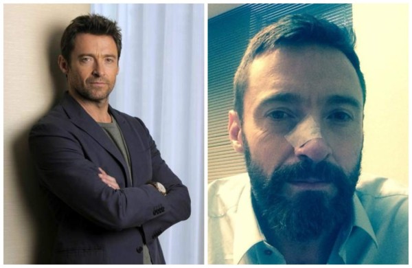 Hugh Jackman es tratado por segunda vez de un carcinoma en la nariz