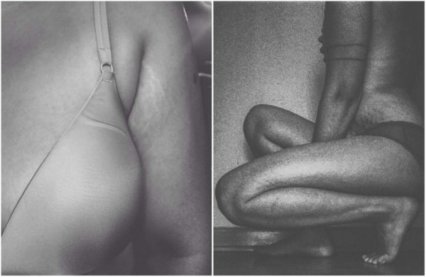 Mujeres comparten fotos de sus estrías para campaña viral