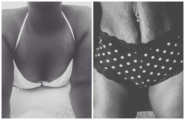 Mujeres comparten fotos de sus estrías para campaña viral