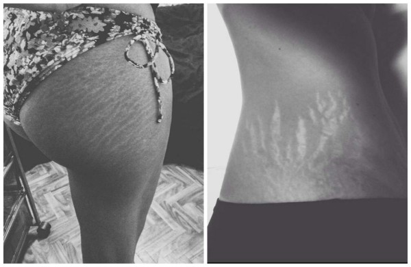 Mujeres comparten fotos de sus estrías para campaña viral