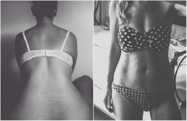 Mujeres comparten fotos de sus estrías para campaña viral