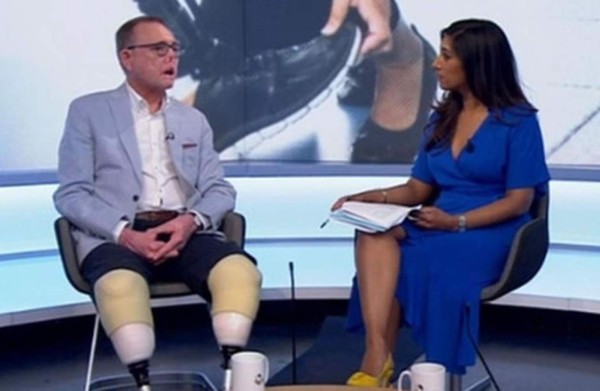 Arañazo de su perro lo deja sin piernas, dedos y rostro desfigurado