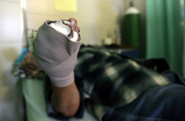 Quince quemados más por pólvora a nivel nacional