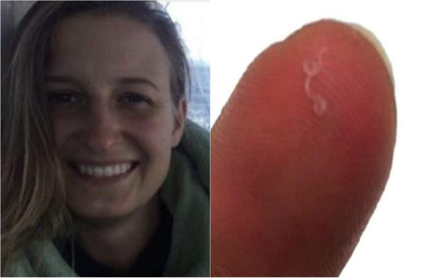 Médicos extraen 14 gusanos del ojo de una mujer en EEUU