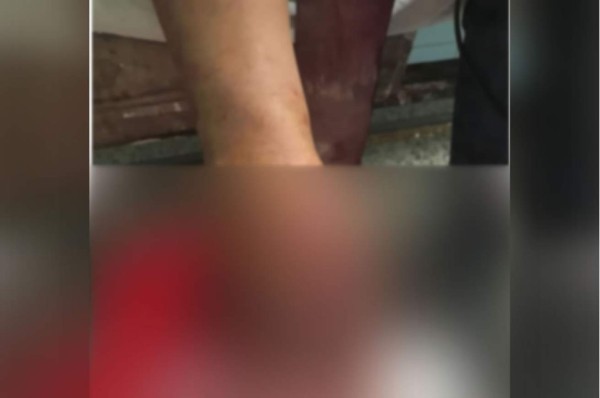 Joven pierde la mano al explotarle un mortero en Intibucá