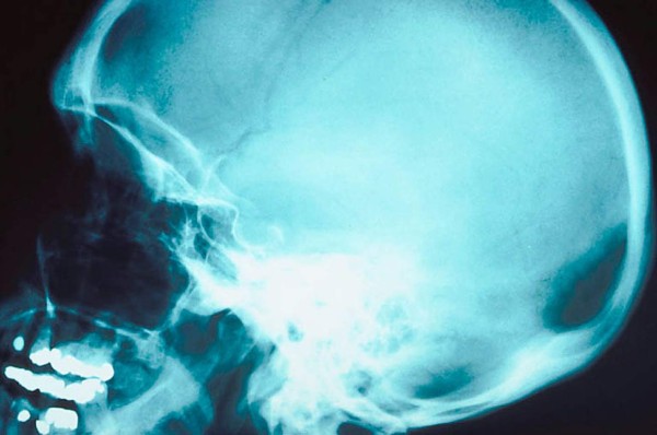 El genio matemático que nació sin cerebro