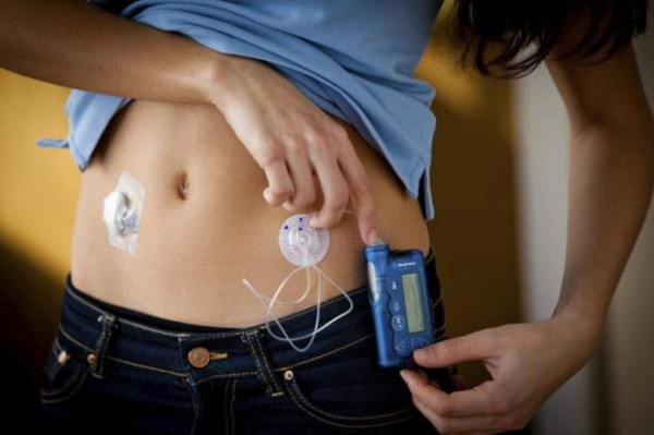Las bombas de insulina reducen el riesgo de muerte por enfermedad cardiaca