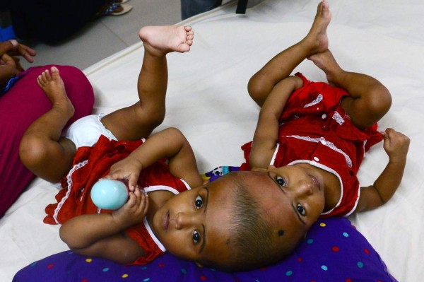 This photo taken on July 25, 2017 shows Bangladeshi conjoined twins baby girls Rabia and Rukia during their visit to a hospital in Dhaka.Bangladeshi twins born conjoined at the skull will undergo a difficult and potentially dangerous operation to separate their bodies, surgeons said July 26 as they appealed for help from global medical experts. Doctors are trying to establish whether the one-year-old girls, born otherwise healthy in northwest Bangladesh, share the same brain, something that would vastly complicate the surgery. / AFP PHOTO / Munir UZ ZAMAN