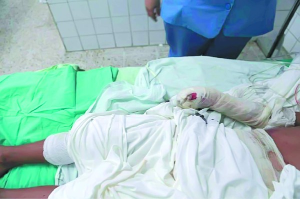 Registran alza de 85% en casos de menores quemados