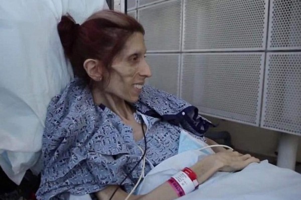 Actriz que pesaba 18 kilos le gana la batalla a la anorexia y así luce ahora