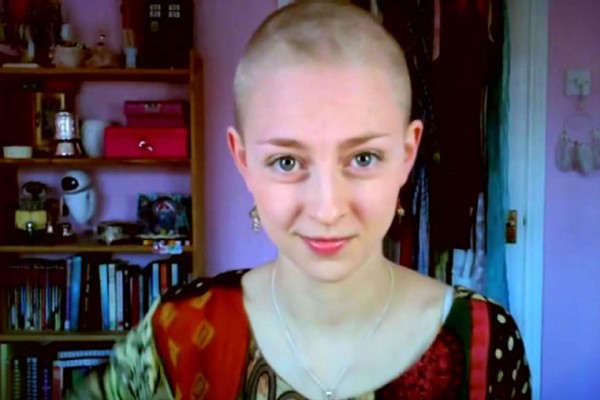 Joven se arranca el pelo debido al transtorno compulsivo que sufre