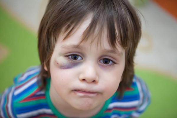 Little boy with a bruised eye.