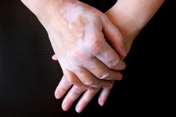 Conozca por qué el COVID-19 está hiperpigmentando la piel y provocando erupciones cutáneas