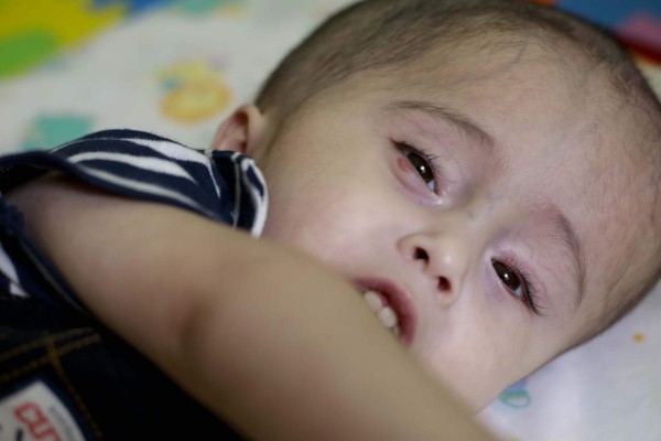 Se unen para que Obed venza la hidrocefalia