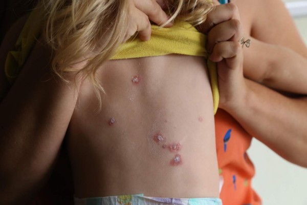 Aumentan los casos de enfermedades de la piel por temporada de calor