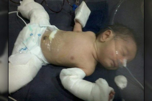 Nace bebé 'embarazado' y asombra a los médicos en India