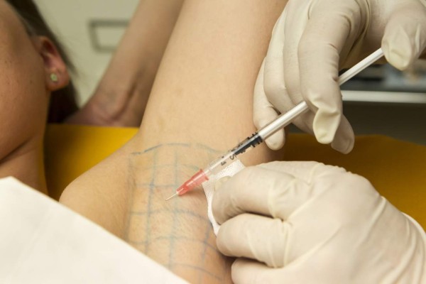 Con toxina botulínica se trata la hiperhidrosis