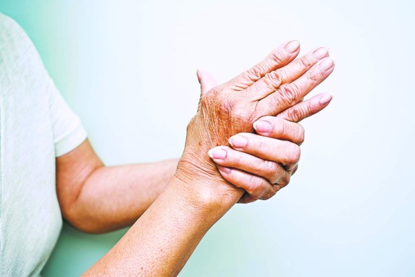 La artritis reumatoide, un mal frecuente en el adulto joven