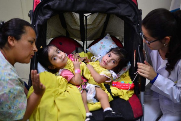 Dadas de alta las siamesas separadas con éxito en 2015 en Guatemala