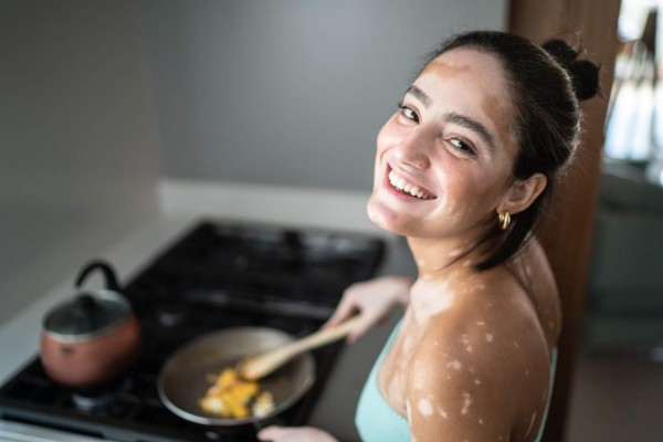 El vitíligo se ensaña más con personas jóvenes