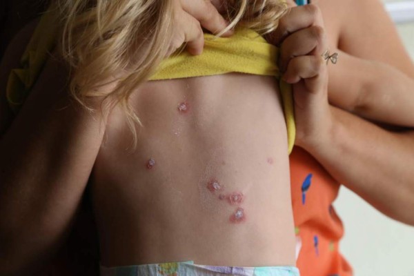 Esteroides pueden causar más daños que beneficios