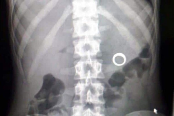 Ladrón termina en hospital tras tragarse aretes de oro en Colombia&nbsp;&nbsp;