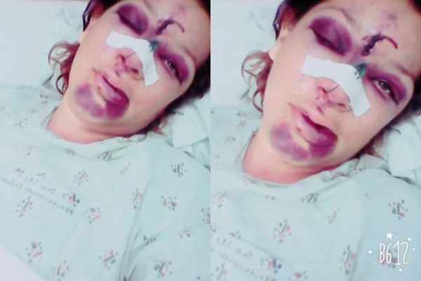 'Siempre ha sido celoso y agresivo”: hondureña golpeada por su marido