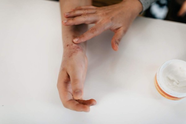 Conozca por qué el COVID-19 está hiperpigmentando la piel y provocando erupciones cutáneas