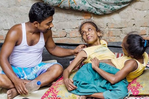 Siamesas de 45 años se enamoran del mismo hombre