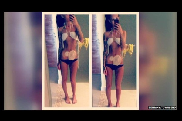 Bethany, la joven que venció los prejuicios con su foto en bikini