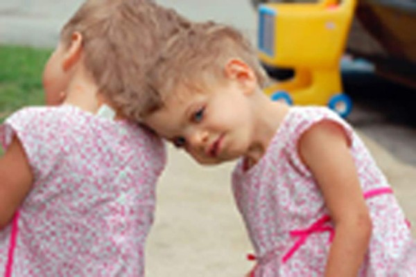 Médicos estadounidenses renuncian a separar a siamesas unidas por la cabeza