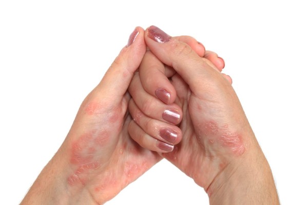 La psoriasis, un mal que afecta la piel y las emociones de quien la sufre