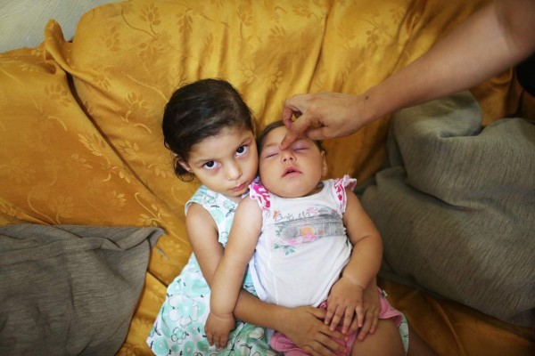 RECIFE, BRAZIL - JUNE 01: Seven-month-old Luhandra Vitoria, who was born with microcephaly, sits with her sister Jasminy on June 1, 2016 in Recife, Brazil. Microcephaly is a birth defect linked to the Zika virus where infants are born with abnormally small heads. A baby girl, whose mother contracted Zika in her native Honduras, was born with Zika-related microcephaly in New Jersey today. The Brazilian city of Recife and surrounding Pernambuco state remain the epicenter of the Zika virus outbreak, which has now spread to many countries in the Americas. A group of health experts recently called for the Rio 2016 Olympic Games to be postponed or cancelled due to the Zika threat but the WHO (World Health Organization) rejected the proposal. (Photo by Mario Tama/Getty Images)