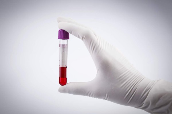 Una biopsia líquida ayuda a médicos a seguir los cambios en los tumores