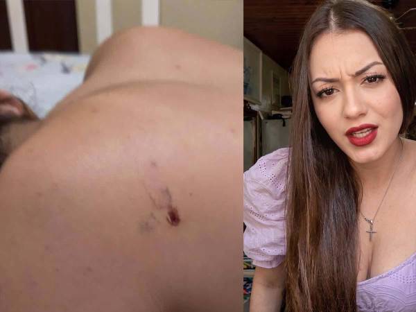 Jennyfer Reyes Castro murió tras sufrir una perforación en los pulmones durante la cirugía estética a la que se sometió en Managua, Nicaragua, según revelan los reportes médicos y la denuncia presentada por sus familiares.