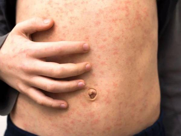 Alerta en Honduras por casos sospechosos de sarampión