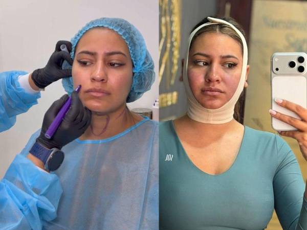 La ex presentadora hondureña Alejandra Rubio volvió a colocarse en el centro de la conversación digital luego de compartir en sus redes sociales detalles de su más reciente procedimiento estético.