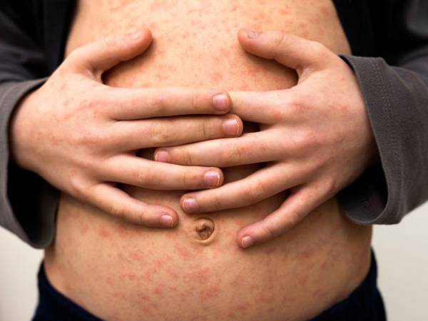 Salud aplicará una dosis adicional de SRP a bebés de seis a once meses ante el riesgo de ingreso del sarampión.