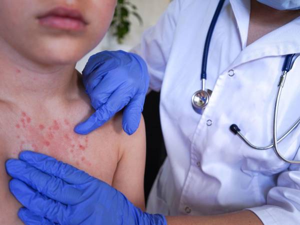 Un niño con síntomas de sarampión es atendido en un centro médico en una fotografía de referencia.