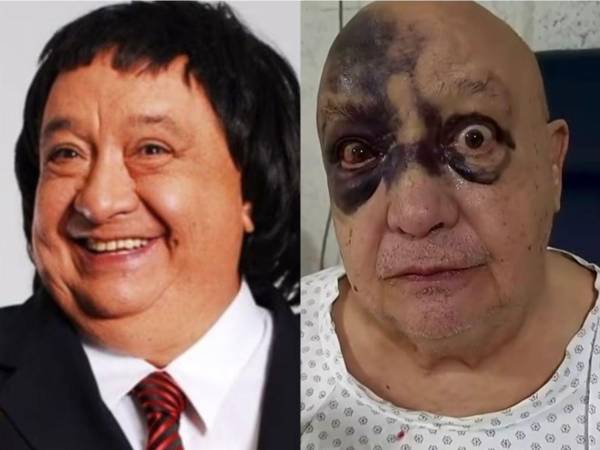 La imagen de Luis de Alba con el rostro cubierto de hematomas encendió las alarmas entre sus seguidores durante las últimas horas. Sin embargo, el reconocido actor y comediante mexicano decidió aparecer públicamente para explicar lo sucedido y tranquilizar a quienes se preocuparon por su estado de salud.