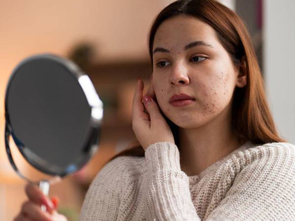 Cambios significativos, como los que se producen durante el embarazo o la menopausia, pueden provocar brotes que luego se atenúan o persisten con el tiempo.
