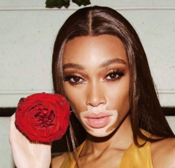 Winnie Harlow nació como Chantelle Brown-Young; Toronto, Ontario, 27 de julio de 1994, es una modelo canadiense y portavoz de la condición de piel llamada vitiligo.