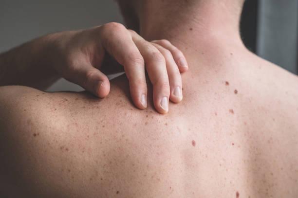 Uno de cada 100 hondureños padece cáncer de piel