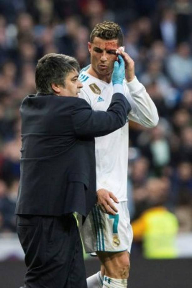 El delantero portugués del Real Madrid tras ser golpeado en la cara por el defensa suizo del Deportivo Fabian Schar.