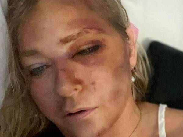 Virginia Giuffre afirma que fue atropellada por un autobús en un incidente que le dejó al borde de la muerte.